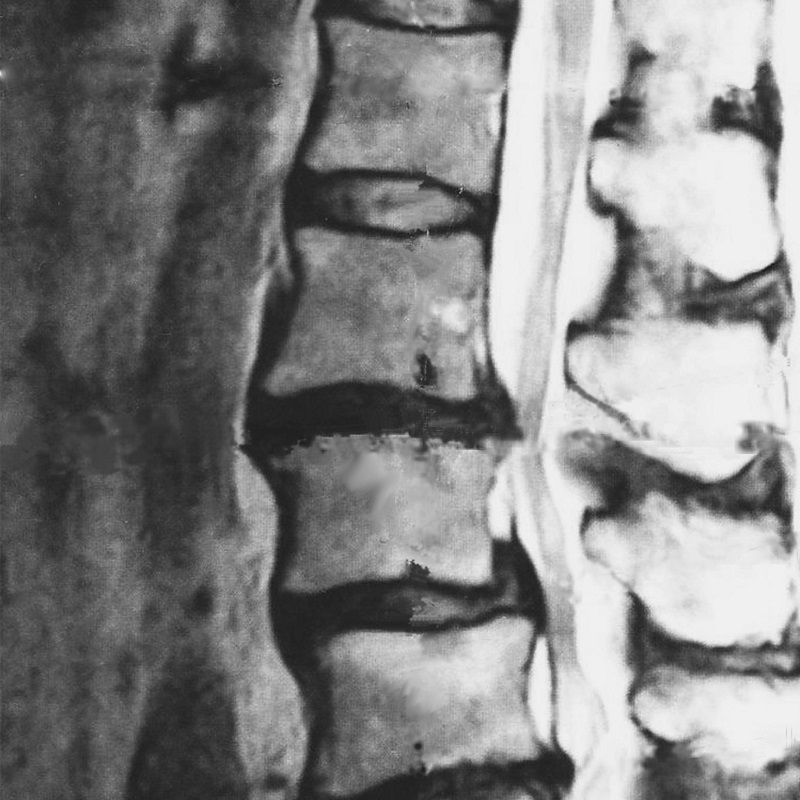 ウォーキング 脊柱 管 狭窄 症 脊柱管狭窄症とウォーキングの関係
